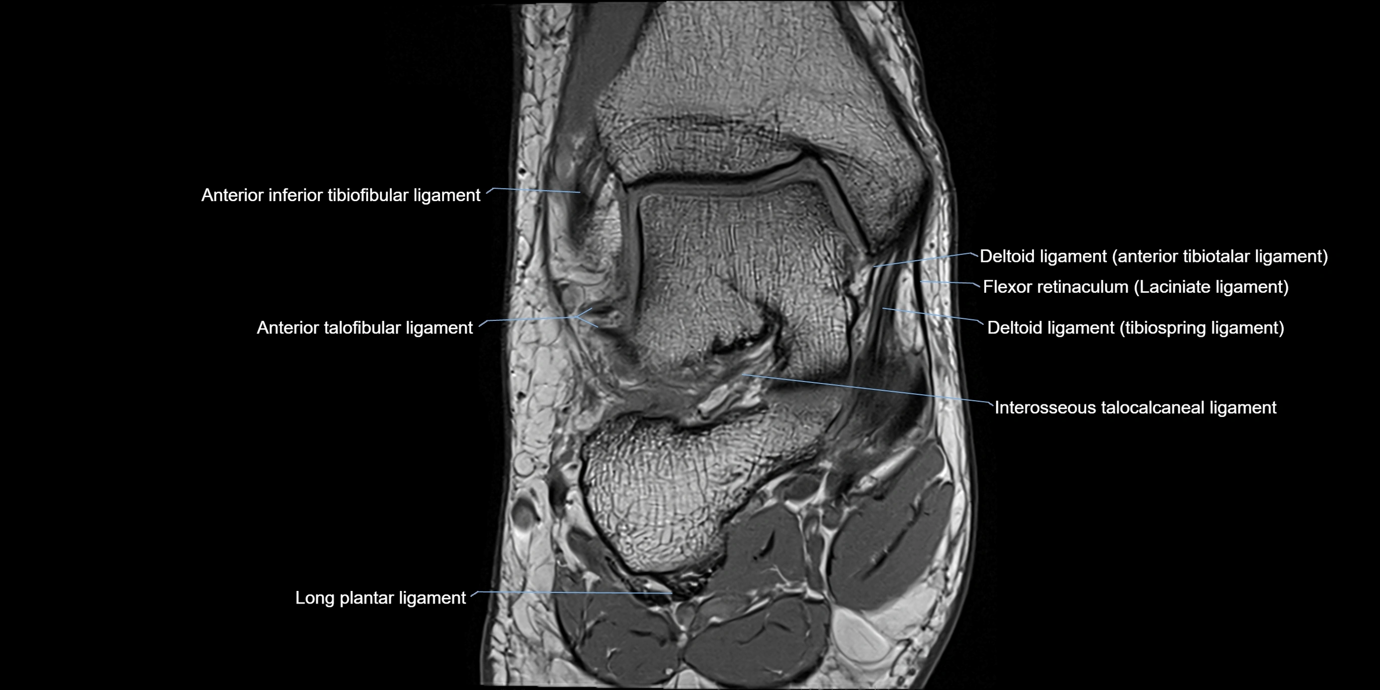 MRI Ankle coronal ligaments cross sectional anatomy 3T  radiology  image-img-00001-00009.webp